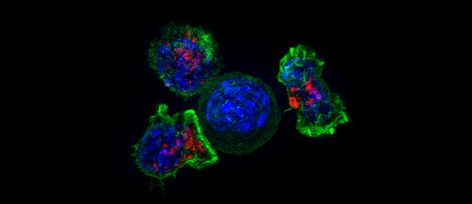 Tcells surround a cancer cell to finish it off, but such interactions do not always end with the T cells victorious. Researchers from Penn detail how cancer cells can prompt T cells to ingest bits of cancer cell membrane, a process known as trogocytosis. The cancer may evade immune detection as a result. (Image: Alex Ritter, Jennifer Lippincott Schwartz and Gillian Griffiths, National Institutes of Health)